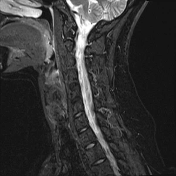 File:Normal trauma cervical spine MRI (Radiopaedia 32130-33071 Sagittal STIR 10).jpg