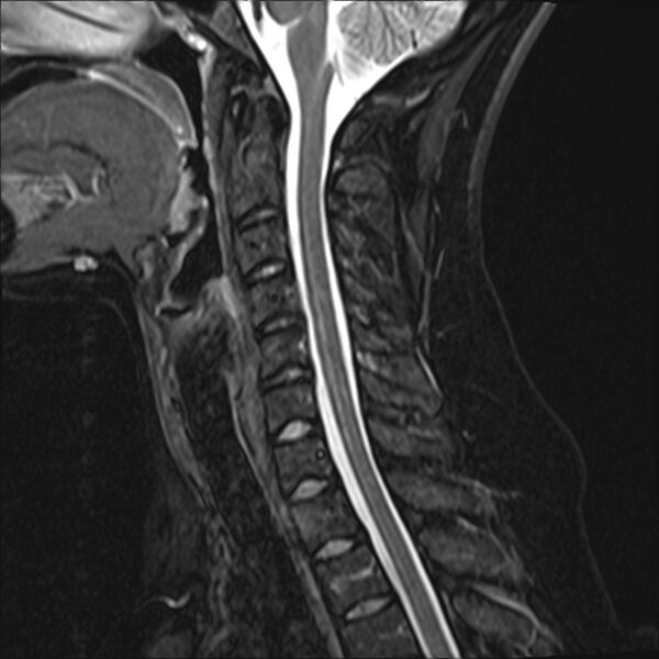 File:Normal trauma cervical spine MRI (Radiopaedia 32130-33071 Sagittal STIR 8).jpg