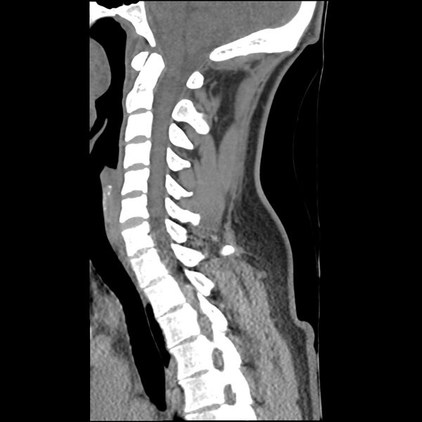 File:Normal trauma spine imaging (Radiopaedia 31753-32686 A 19).jpg
