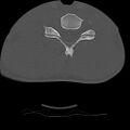 Normal trauma spine imaging (age 16) (Radiopaedia 45335-49358 Axial bone window 57).jpg