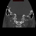 Occipital condyle fracture (Radiopaedia 18366-18208 Coronal bone window 13).jpg