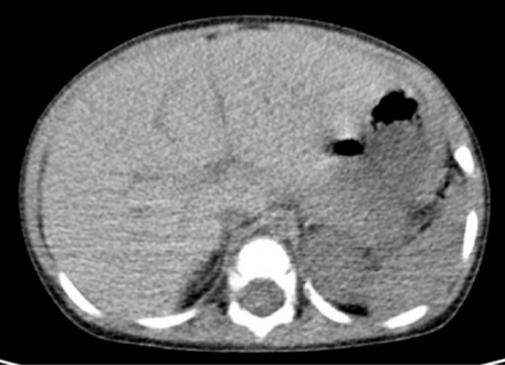 Computed tomography finding of hepatomegaly.