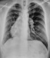 Partial anomalous pulmonary venous return (Radiopaedia 35312).jpg