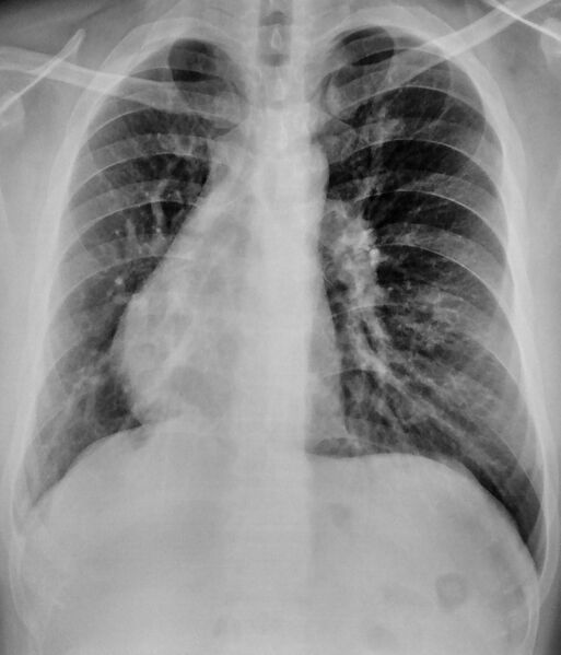 File:Partial anomalous pulmonary venous return (Radiopaedia 35312).jpg