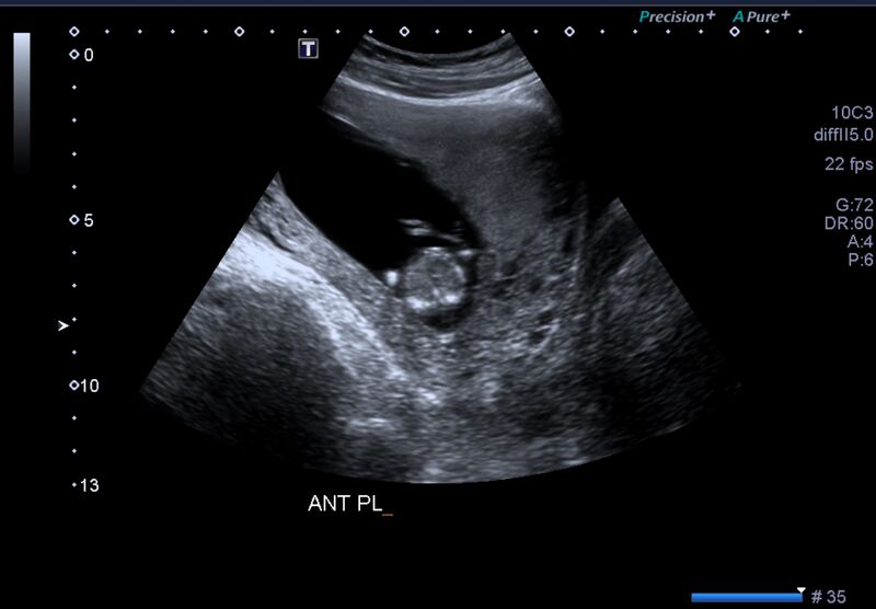 File:1st trimester nuchal-morphology ultrasound (Radiopaedia 44706-48477 General anatomy and NT 49).jpg