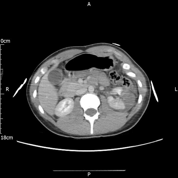 File:AAST grade IV kidney injury with CEUS follow-up (Radiopaedia 72353-82877 Axial C+ portal venous phase 28).jpg