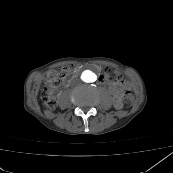 File:Abdominal aortic aneurysm (Radiopaedia 23703-23856 Axial C+ arterial phase 46).jpg