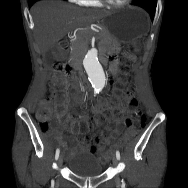 File:Abdominal aortic aneurysm (Radiopaedia 23703-23856 Coronal C+ arterial phase 7).jpg