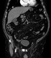 Abdominal aortic aneurysm (Radiopaedia 25855-26001 Coronal C+ arterial phase 11).jpg