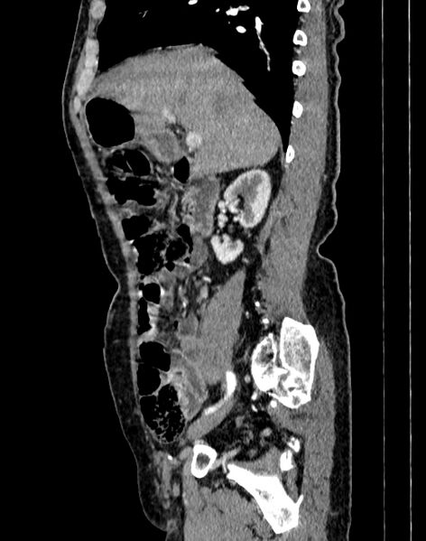 File:Abdominal aortic aneurysm (Radiopaedia 83581-98689 Sagittal C+ arterial phase 9).jpg