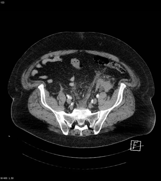 File:Abdominal aortic aneurysm with intramural hematoma then rupture (Radiopaedia 50278-55632 Axial C+ arterial phase 132).jpg