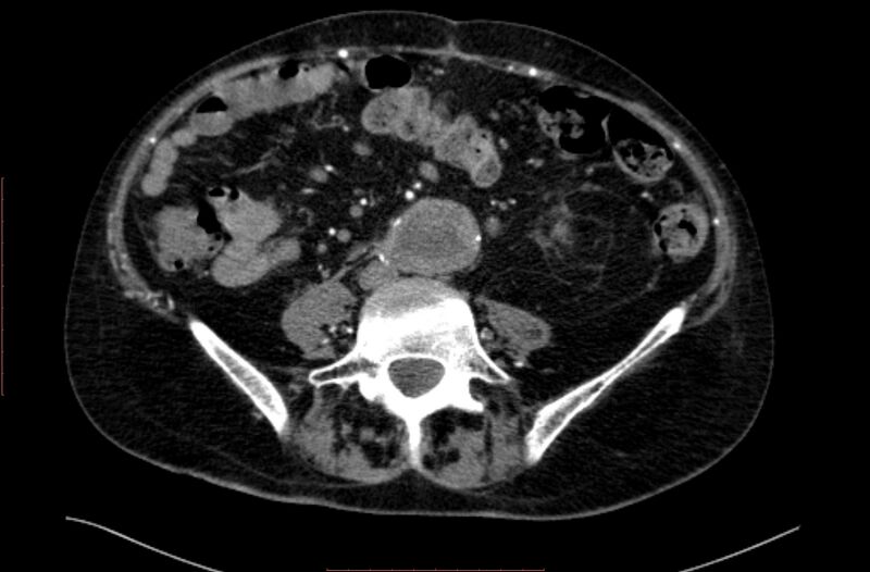 File:Abdominal aortic interposition tube graft and aneurysm thrombosis (Radiopaedia 71438-81857 Axial C+ arterial phase 119).jpg