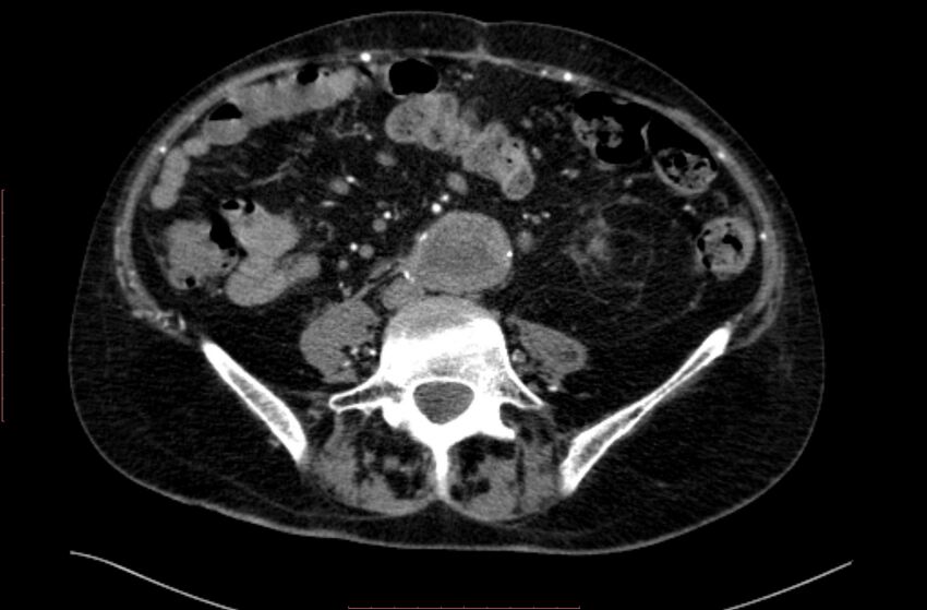 Abdominal aortic interposition tube graft and aneurysm thrombosis (Radiopaedia 71438-81857 Axial C+ arterial phase 119).jpg