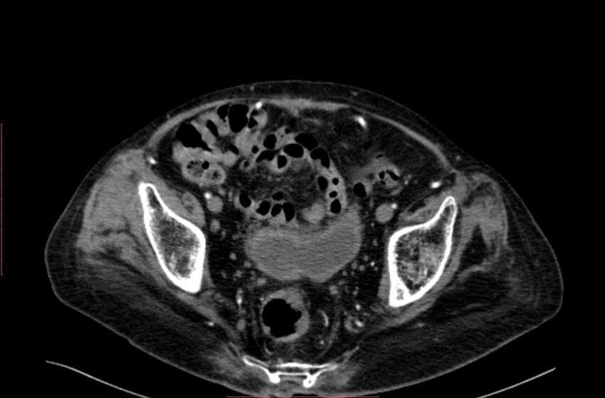Abdominal aortic interposition tube graft and aneurysm thrombosis (Radiopaedia 71438-81857 Axial C+ arterial phase 203).jpg
