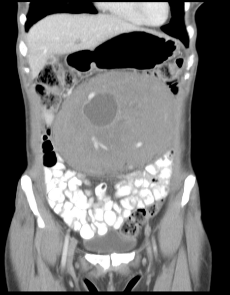 File:Abdominal desmoid tumor (Radiopaedia 41007-43740 Coronal C+ portal venous phase 12).png