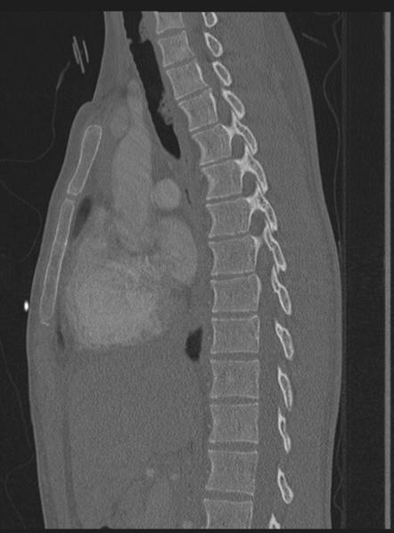File:Abdominal multi-trauma - devascularised kidney and liver, spleen and pancreatic lacerations (Radiopaedia 34984-36486 Sagittal bone window 38).png