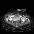 Abdominal wall recurrence after colorectal resection for cancer (Radiopaedia 23444-23523 Axial C+ portal venous phase 38).jpg
