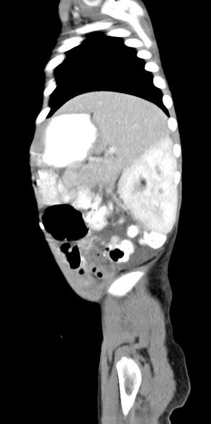 File:Abdominopelvic rhabdomyosarcoma (Radiopaedia 78356-90984 Sagittal C+ portal venous phase 19).jpg