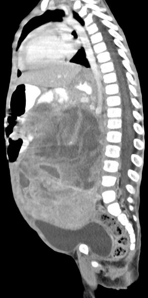 File:Abdominopelvic rhabdomyosarcoma (Radiopaedia 78356-90984 Sagittal C+ portal venous phase 42).jpg