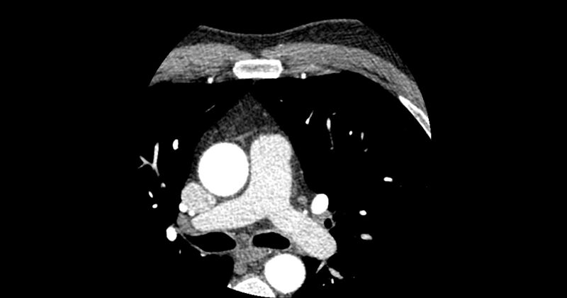 File:Aberrant left main coronary artery (ALMCA) arising from the right sinus with interarterial course (Radiopaedia 63251-71814 Axial C+ arterial phase 20).JPG