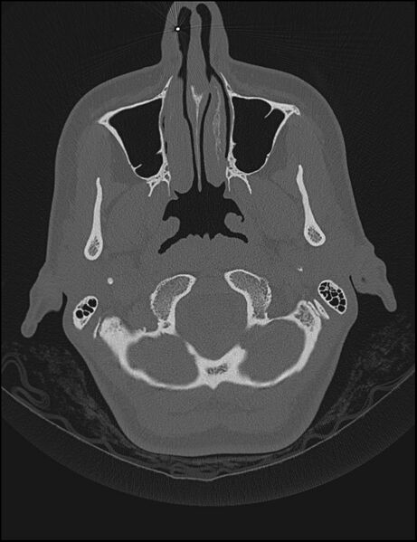 File:Aberrant right internal carotid artery (Radiopaedia 65191-74198 Axial non-contrast 11).jpg