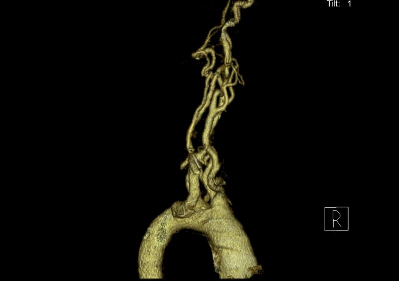 File:Aberrant right subclavian artery (Radiopaedia 19283-19294 3D reconstruction C+ arterial phase 30).jpg