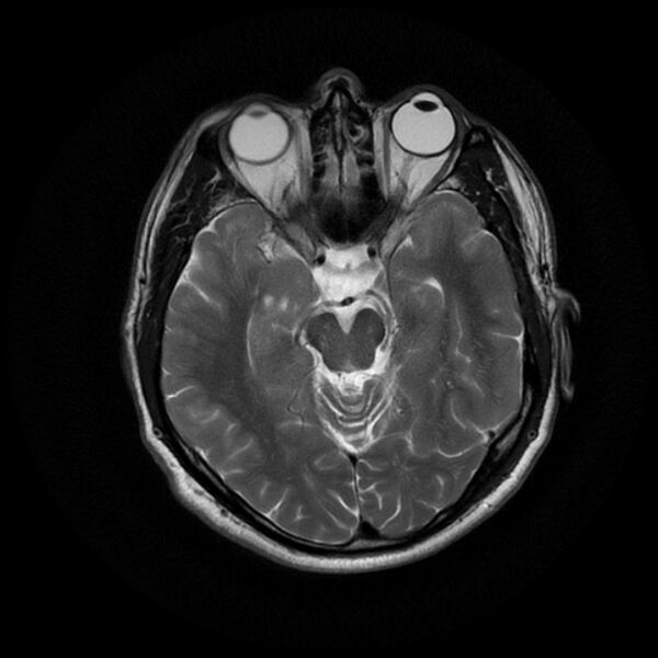 File:Acoustic schwannoma - intracanalicular (Radiopaedia 37247-39024 Axial T2 9).jpg