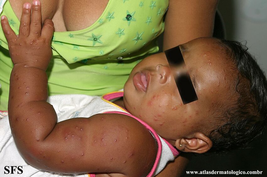 Acrodermatitis Infantile Papular (Dermatology Atlas 25).jpg