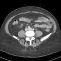 Acute acalculous cholecystitis (Radiopaedia 48250-53123 Axial C+ portal venous phase 39).png
