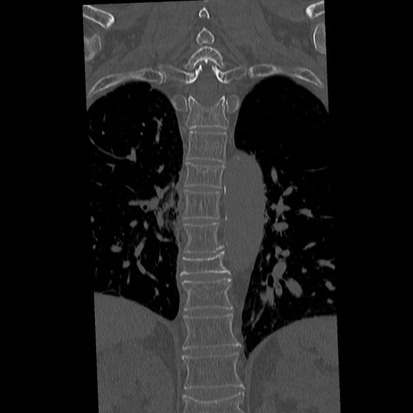 File:Acute and chronic vertebral compression fractures (Radiopaedia 31608-32494 Coronal bone window 21).jpg