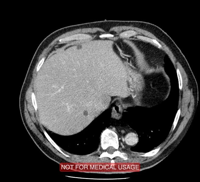 File:Acute aortic dissection - Stanford type A (Radiopaedia 40661-43285 Axial C+ portal venous phase 54).jpg