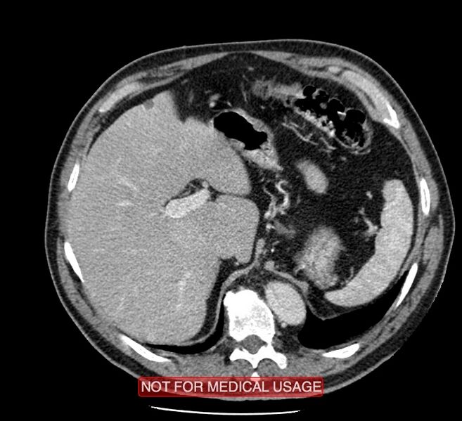 File:Acute aortic dissection - Stanford type A (Radiopaedia 40661-43285 Axial C+ portal venous phase 66).jpg