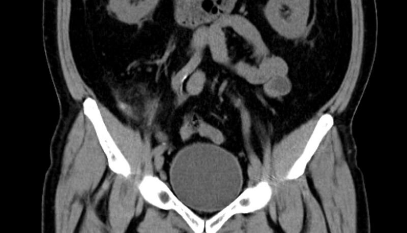File:Acute appendicitis (Radiopaedia 13030-13091 Coronal non-contrast 11).jpg