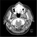 Acute left parotid sialadenitis (Radiopaedia 26160-26295 C+ arterial phase 12).jpg