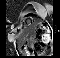 Acute myocarditis (Radiopaedia 40718-43366 Short axis LGE 7).PNG