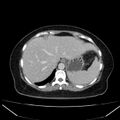 Acute pancreatitis - Balthazar C (Radiopaedia 26569-26714 Axial C+ portal venous phase 24).jpg