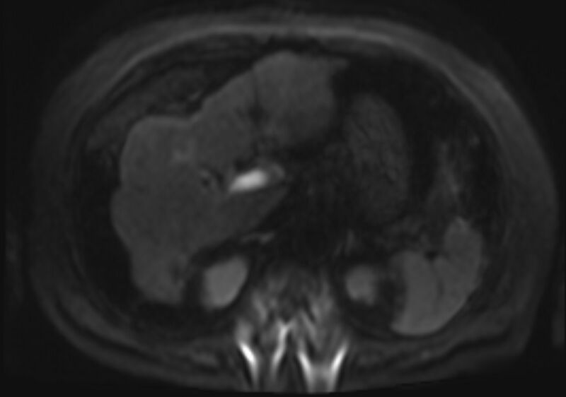 File:Acute portal vein thrombosis (Radiopaedia 73198-83925 Axial DWI 44).jpg