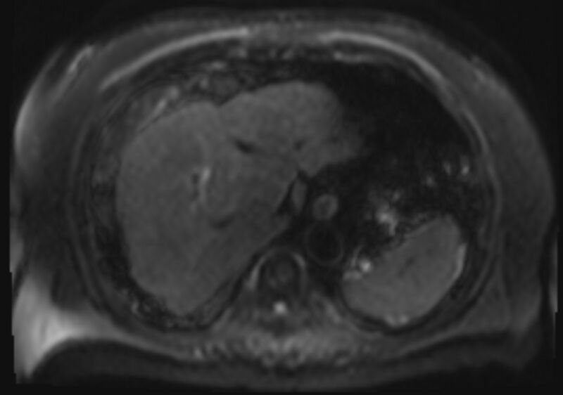 File:Acute portal vein thrombosis (Radiopaedia 73198-83925 Axial DWI 9).jpg