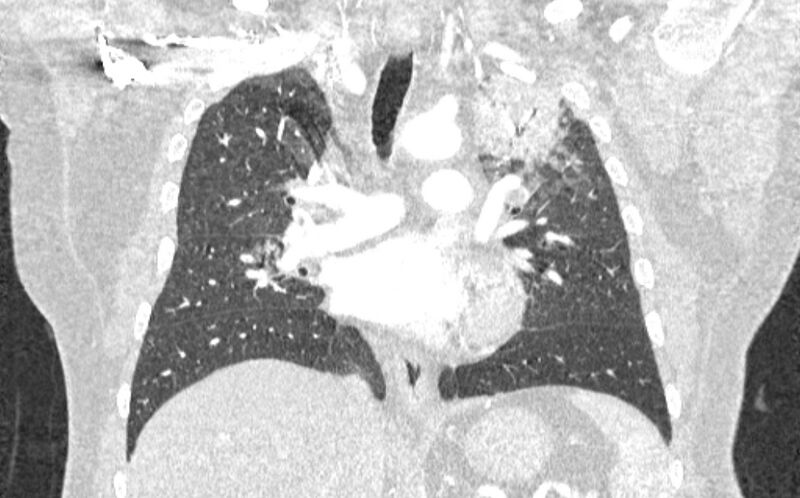 File:Acute pulmonary embolism with pulmonary infarcts (Radiopaedia 77688-89908 Coronal lung window 48).jpg
