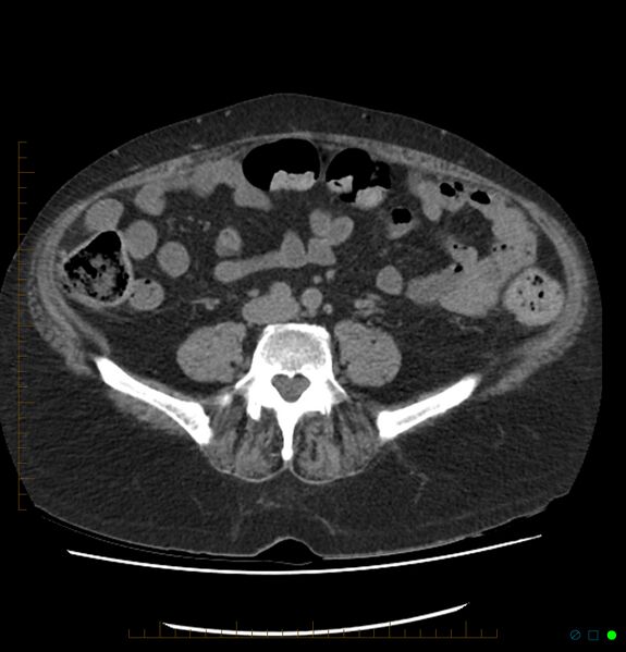 File:Acute renal failure post IV contrast injection- CT findings (Radiopaedia 47815-52557 Axial non-contrast 52).jpg