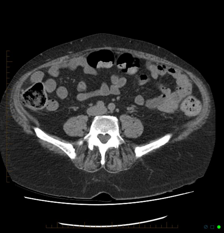 Acute renal failure post IV contrast injection- CT findings (Radiopaedia 47815-52557 Axial non-contrast 52).jpg