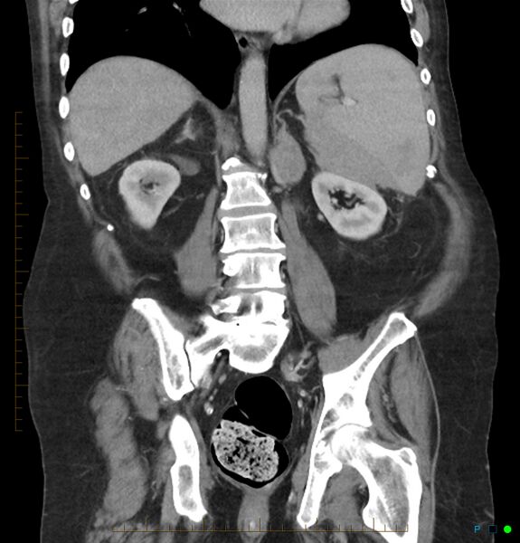 File:Acute renal failure post IV contrast injection- CT findings (Radiopaedia 47815-52559 Coronal C+ portal venous phase 22).jpg