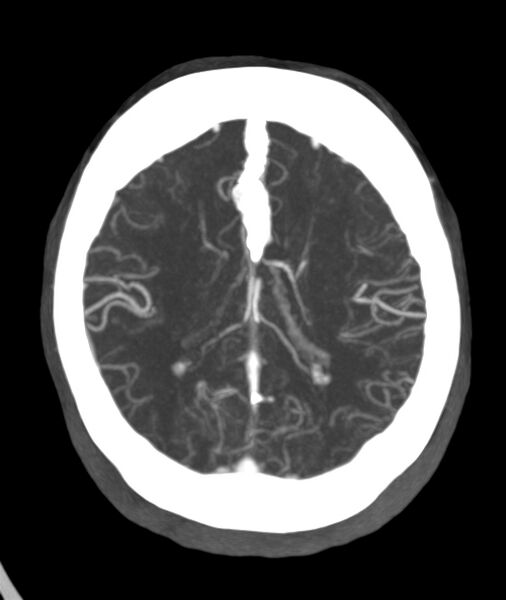 File:Acute right MCA M1 occlusion (Radiopaedia 62268-70454 Axial Phase 2 10).jpg