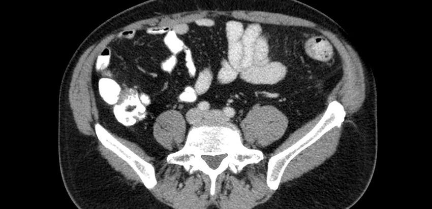 Acute sigmoid colon diverticulitis (Radiopaedia 55507-61976 Axial C+ portal venous phase 55).jpg