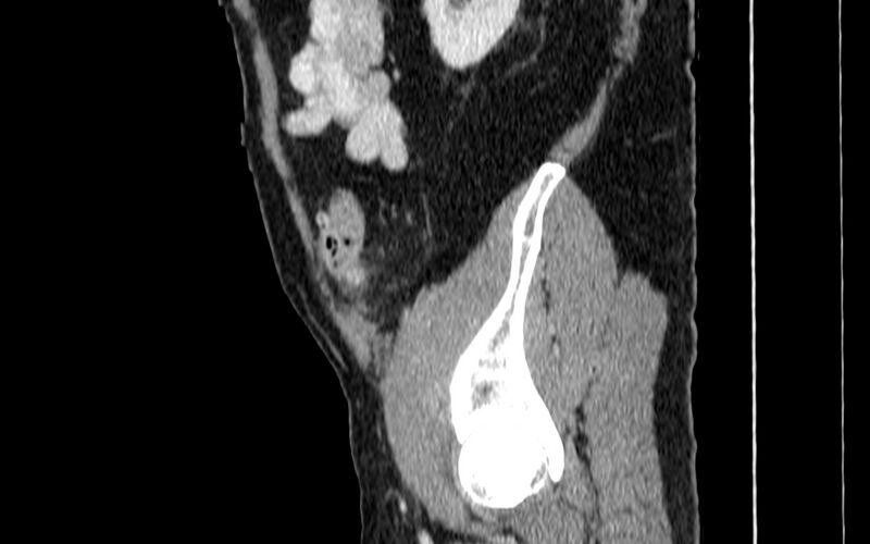 File:Acute sigmoid colon diverticulitis (Radiopaedia 55507-61976 Sagittal C+ portal venous phase 105).jpg