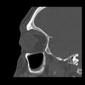 Acute sinusitis (Radiopaedia 23161-23215 Sagittal bone window 48).jpg