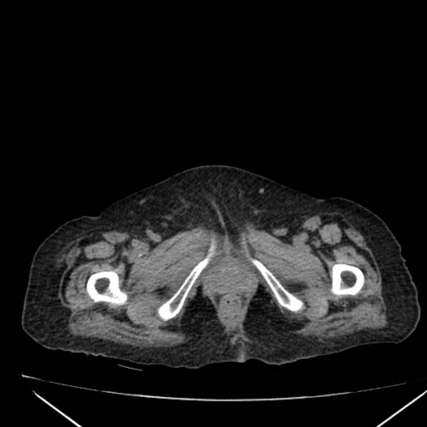 File:Acute tubular necrosis (Radiopaedia 28077-28334 Axial non-contrast 73).jpg