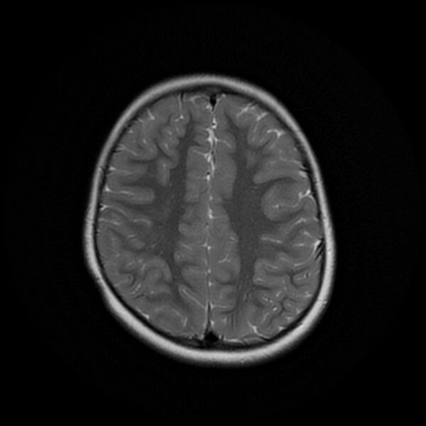 File:Adamantinomatous craniopharyngioma (Radiopaedia 77407-89529 Axial T2 19).jpg