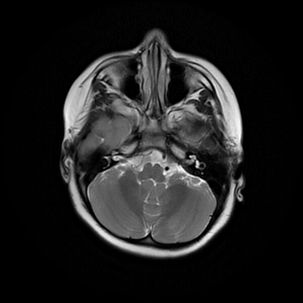 File:Adamantinomatous craniopharyngioma (Radiopaedia 77407-89529 Axial T2 6).jpg