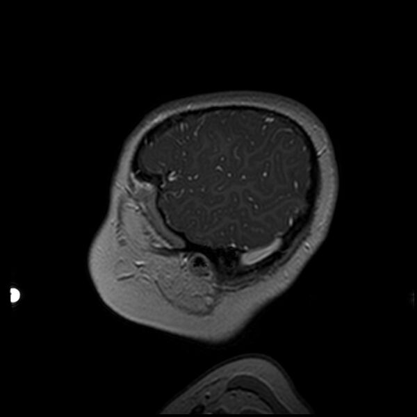 File:Adamantinomatous craniopharyngioma (Radiopaedia 77407-89529 H 15).jpg